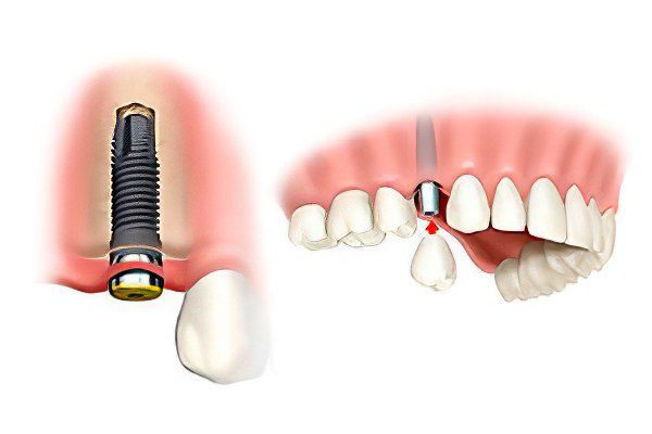 Dental implantation