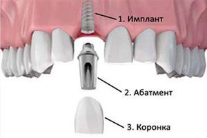 Dental implants &#8211; how they are installed, how long they last?