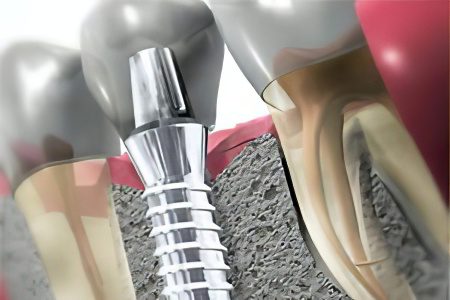 Dental implants - how they are installed, how long they last?