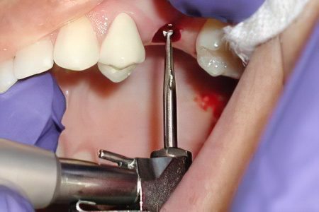 Dental implants - how they are installed, how long they last?