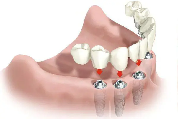 Dental prosthetics