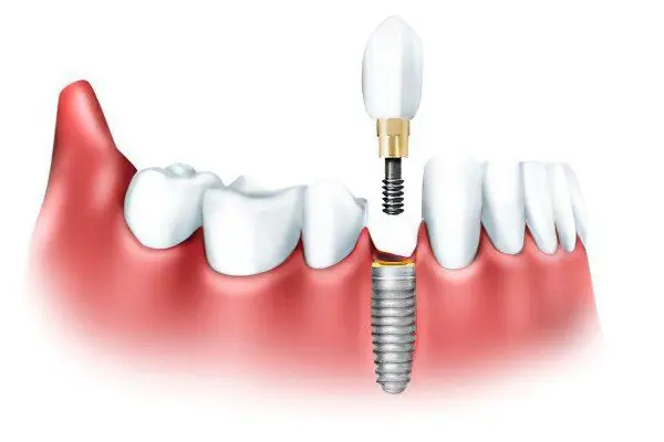 Dental prosthetics