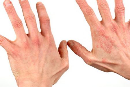 Dermatitis: causes, symptoms, treatment