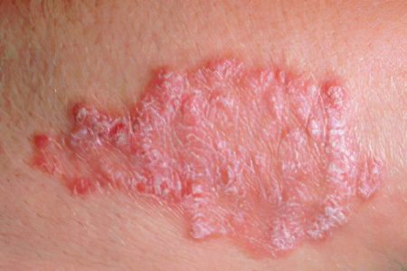 Dermatitis: causes, symptoms, treatment