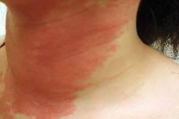 Dermatitis: causes, symptoms, treatment