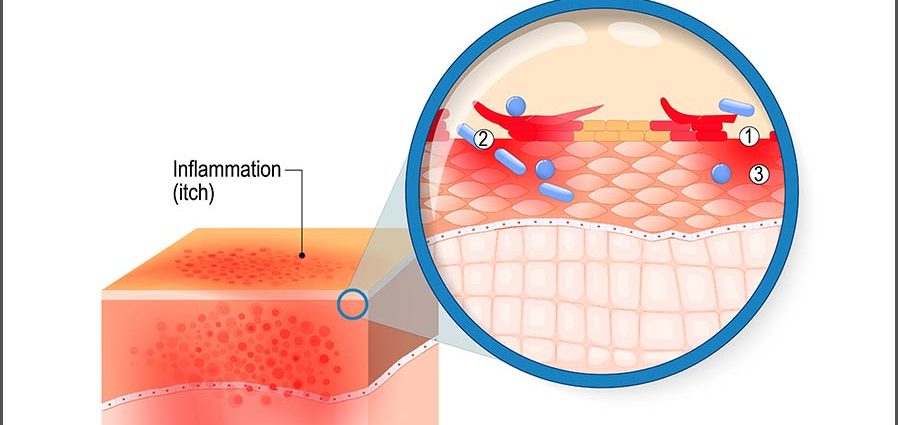 Dermatitis: causes, symptoms, treatment