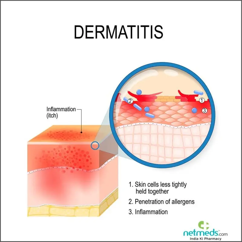 Dermatitis: causes, symptoms, treatment