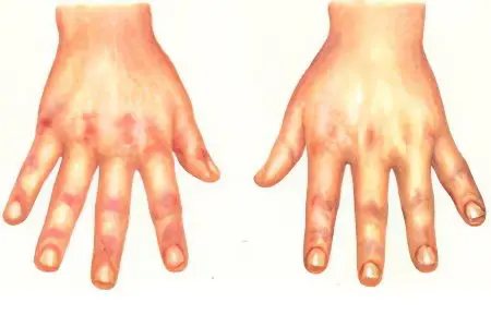 Dermatomyositis: the first symptoms, forms and treatment