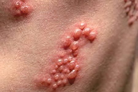 Description, symptoms and treatment of all types of herpes virus