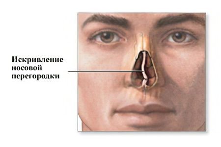 Deviated septum