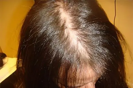 Diffuse alopecia