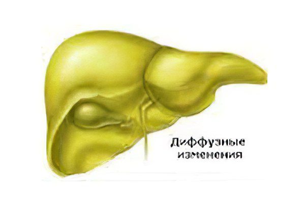 Diffuse changes in the liver parenchyma