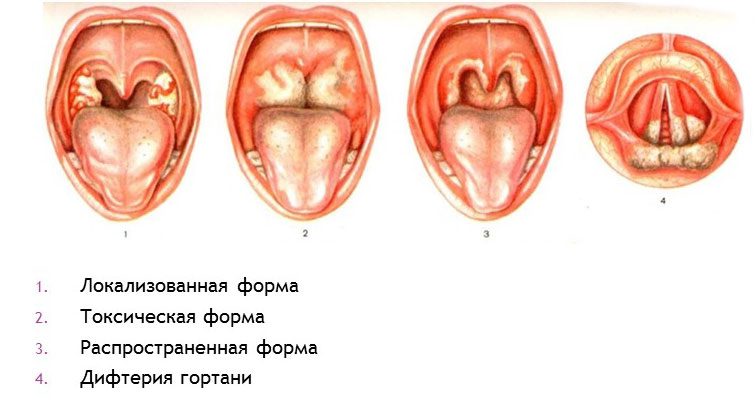 Diphtheria: symptoms and treatment