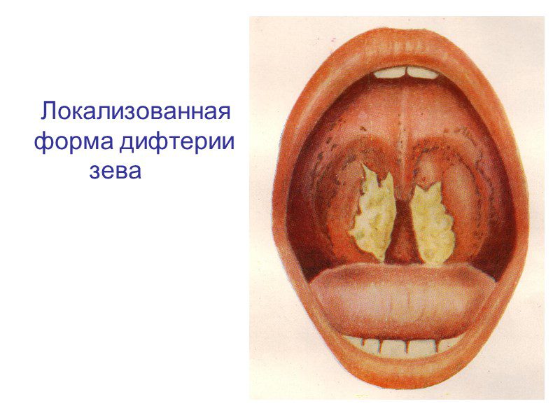 Diphtheria: symptoms and treatment