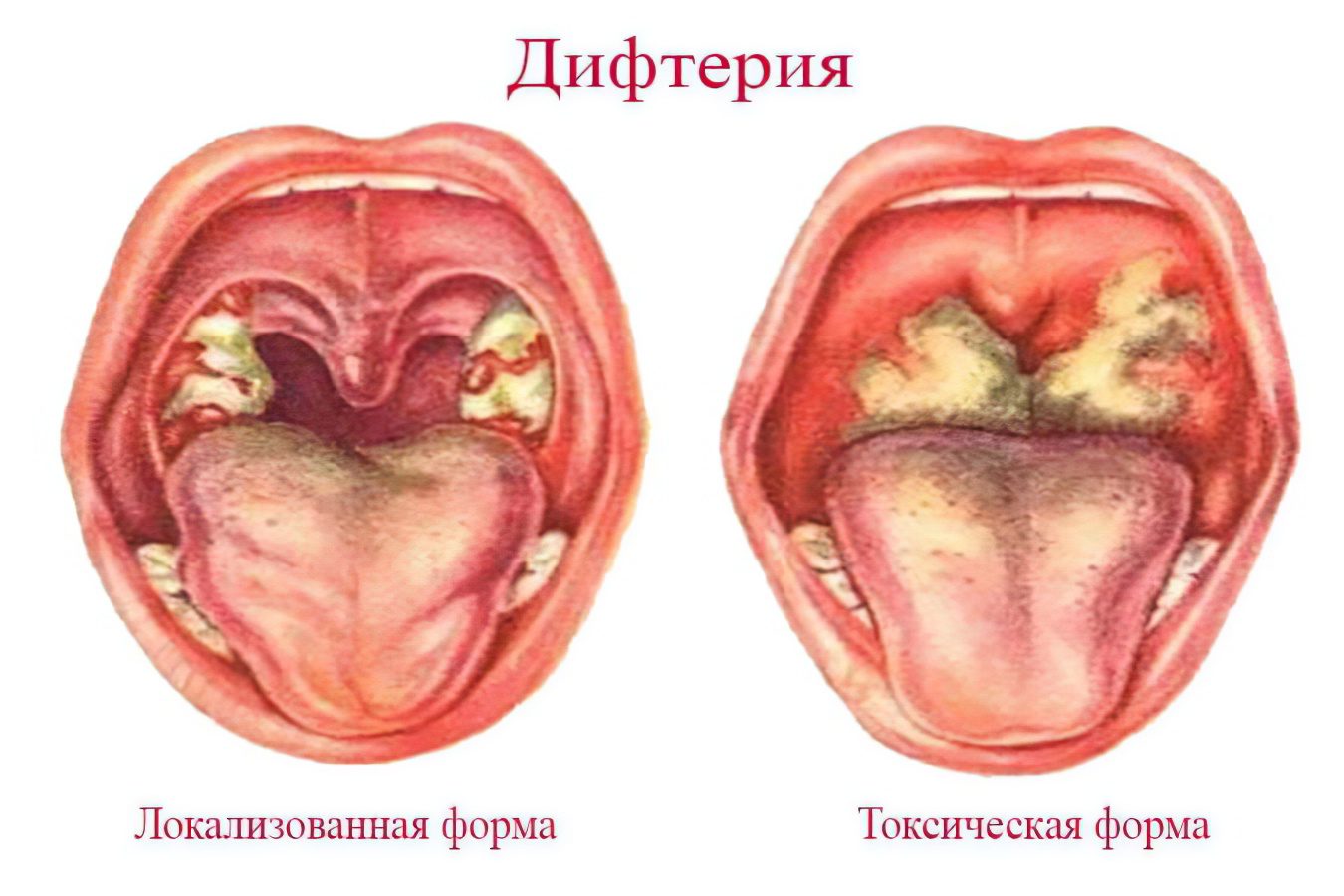 Diphtheria: symptoms and treatment