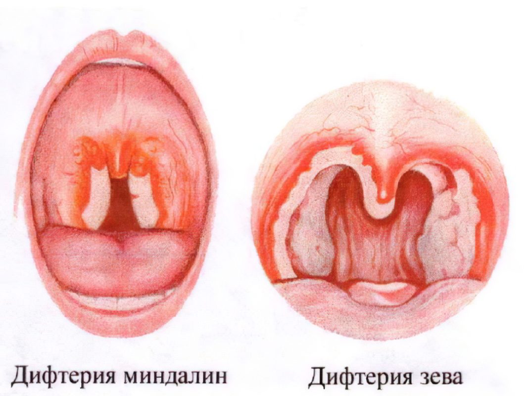 Diphtheria: symptoms and treatment