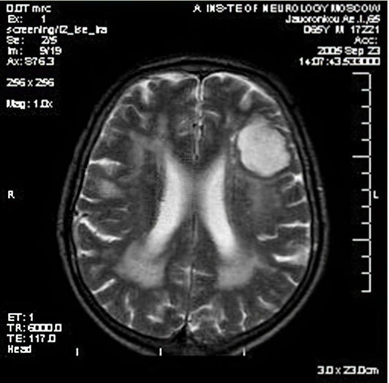 Diseases of the nervous system