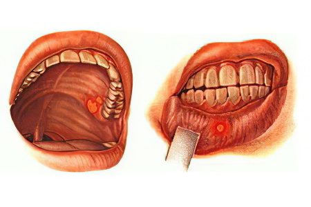 Diseases of the oral mucosa