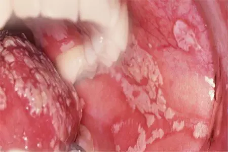 Diseases of the oral mucosa