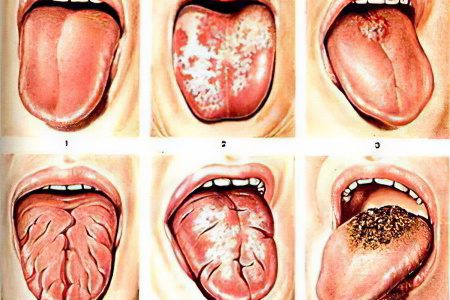 Diseases of the oral mucosa