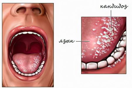 Diseases of the oral mucosa