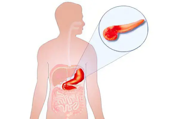 Diseases of the pancreas