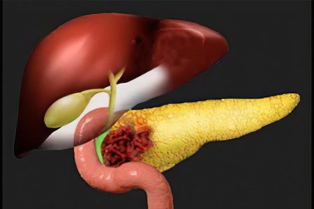 Diseases of the pancreas