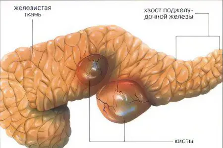 Diseases of the pancreas