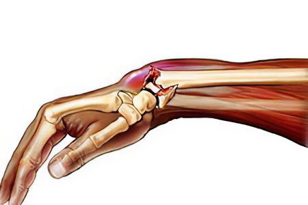 Dislocation of the hand: what to do?