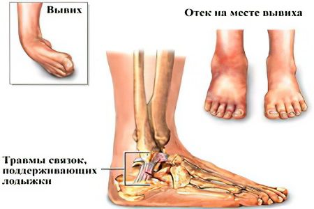 Dislocation of the leg