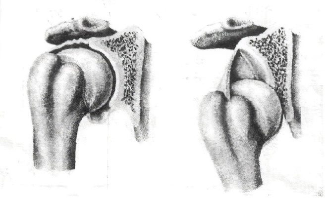 Dislocation of the shoulder (shoulder joint)