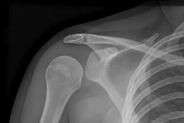 Dislocation of the shoulder (shoulder joint)