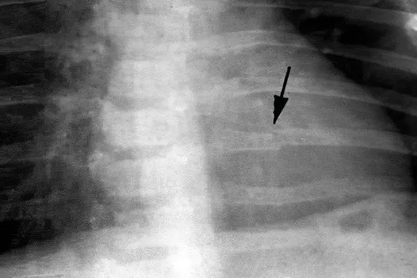 Displaced rib fracture