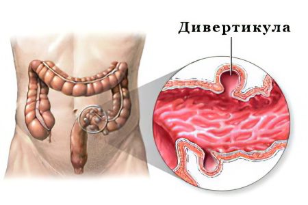 Diverticulosis of the intestine &#8211; what is it? How to treat?