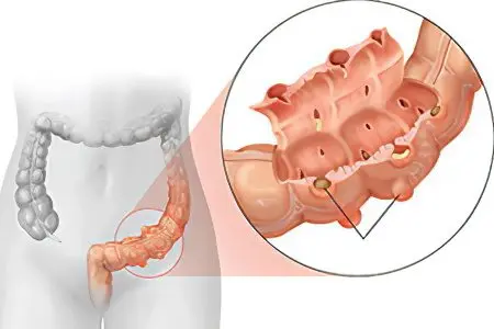 Diverticulosis of the intestine - what is it? How to treat?