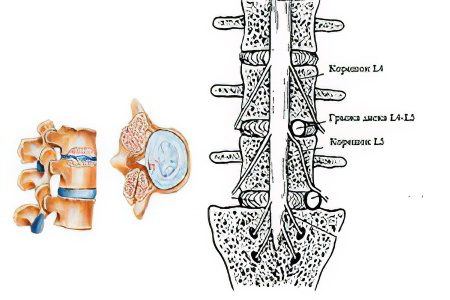 Dorsal hernia l5-s1 and l4-l5