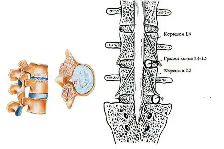 Dorsal hernia l5-s1 and l4-l5