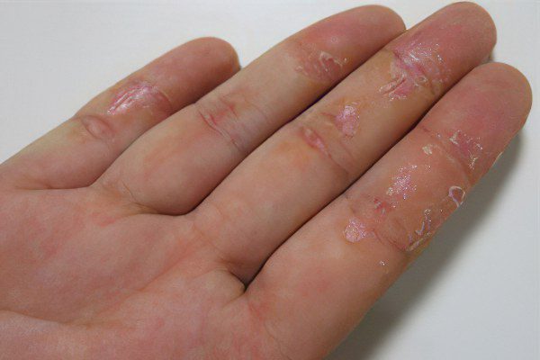 Dry eczema on hands and feet