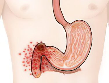 Úlcera duodenal: causas, síntomas, tratamento