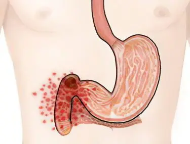 Duodenal ulcer: causes, symptoms, treatment