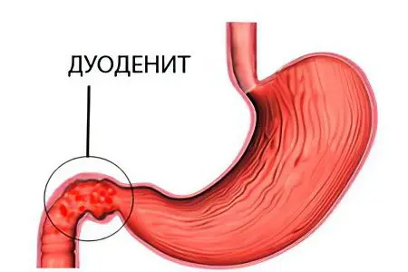 Duodenitis: symptoms and treatment