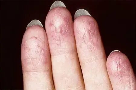 Dyshidrotic eczema on fingers