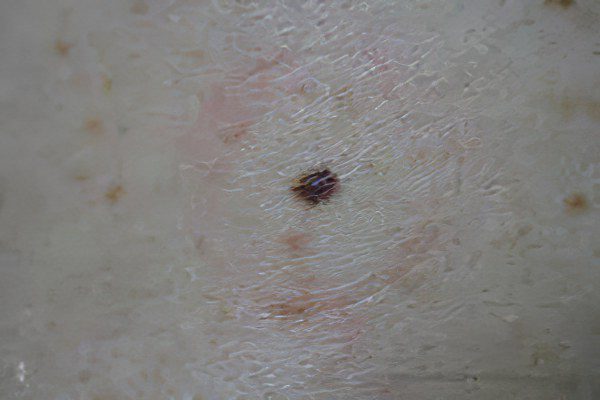 Dysplastic nevus