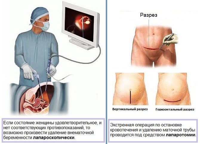 Ectopic pregnancy: first signs, consequences, what to do?