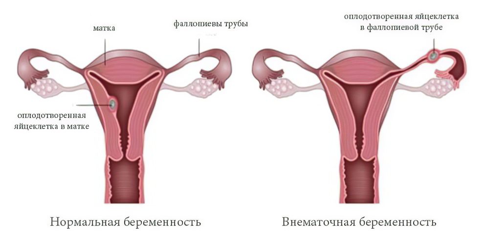 Ectopic pregnancy: first signs, consequences, what to do?