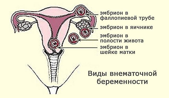 Ectopic pregnancy: first signs, consequences, what to do?