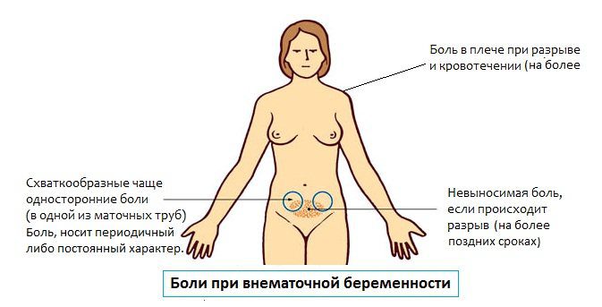 Ectopic pregnancy: first signs, consequences, what to do?