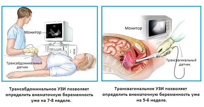 Ectopic pregnancy: first signs, consequences, what to do?