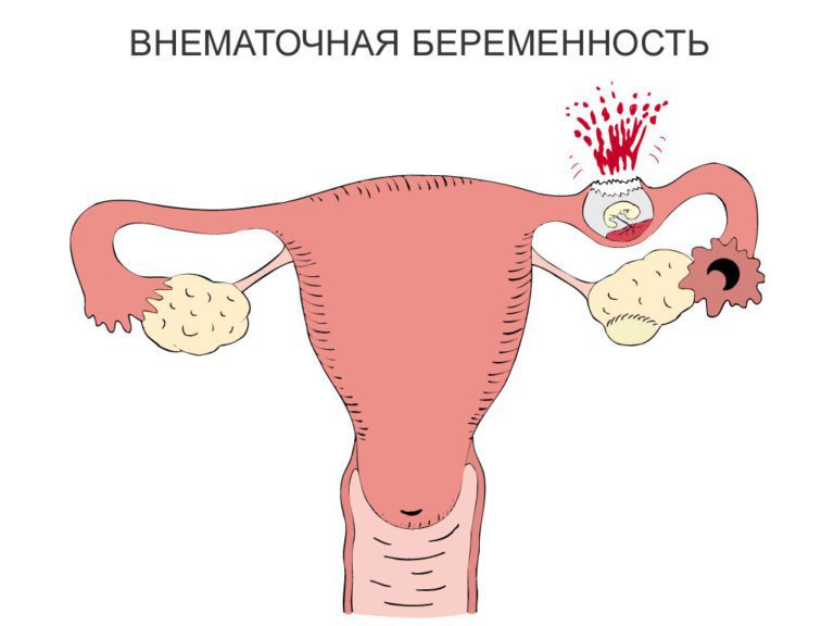 Ectopic pregnancy: first signs, consequences, what to do?