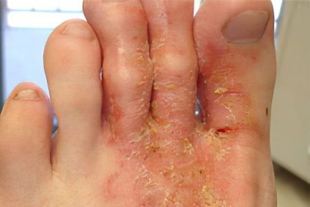 Eczema on the feet